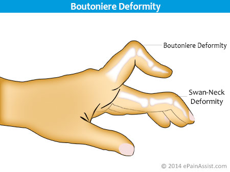 iOS9.1新增豎中指表情!但蘋果把它畫錯了 iOS9.1新增豎中指表情!但蘋果把它畫錯了